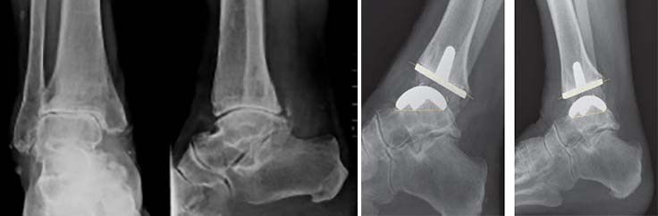 artroza la glezna cum să tratezi o articulație inflamată a genunchiului