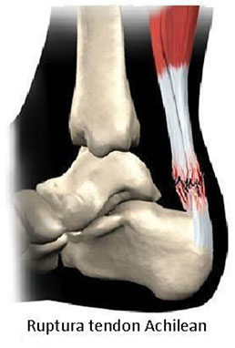artroza tendonului